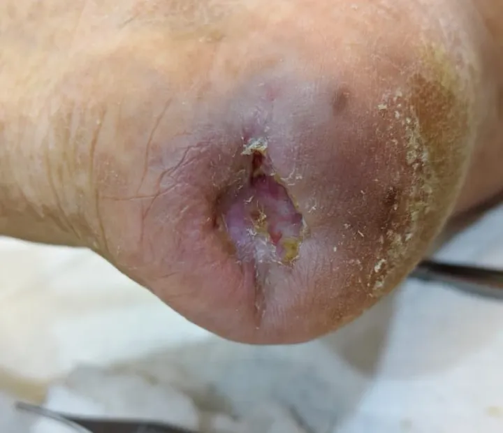 Luka pada belakang tumit — foto dokumentasi klinikal