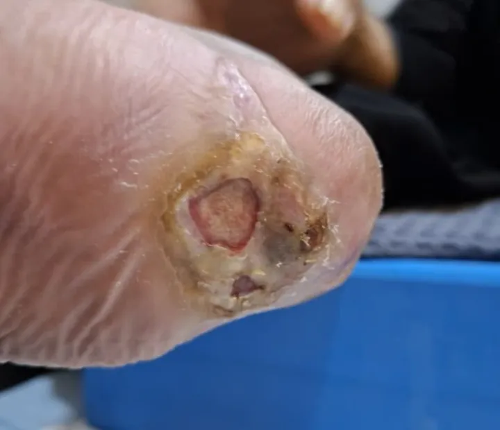 Luka pada kawasan tumit — foto dokumentasi klinikal