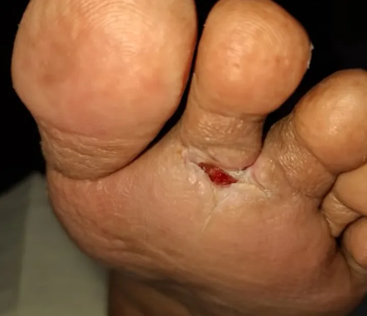 Luka pada bahagian tapak kaki — foto dokumentasi klinikal